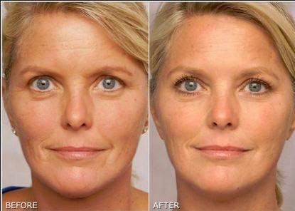 Retinol Gel 0.1% – Vitamin A Night Treatment